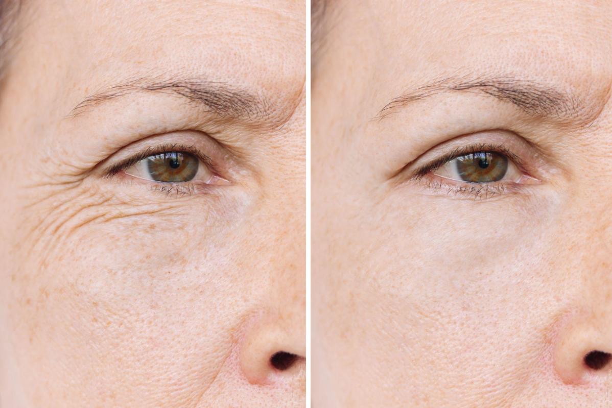 Resultados de rejuvenecimiento facial en Colombia Care Medellín